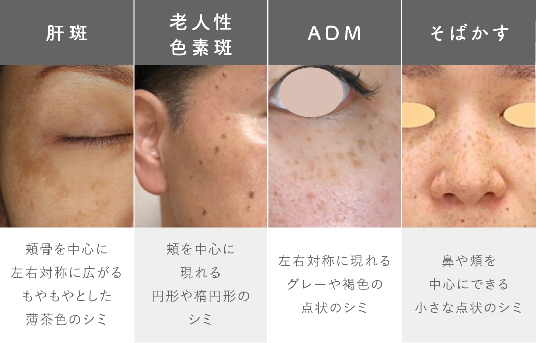 【写真で解説】<br />
あなたのシミはどのタイプ？