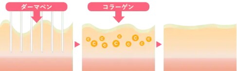 「創傷治癒力」×「薬剤浸透」のダブル効果<br />
