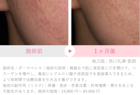 凸凹だった肌が、滑らかに改善