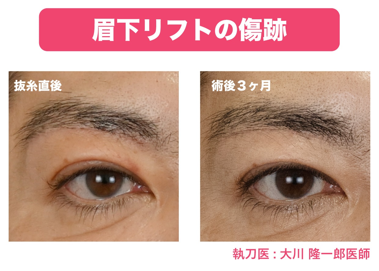 眉下リフトの傷跡