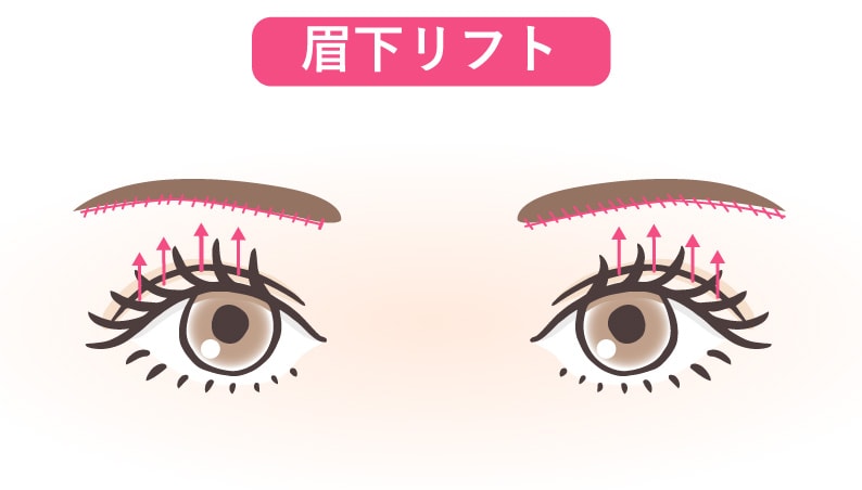 眉下リフト(切る治療)