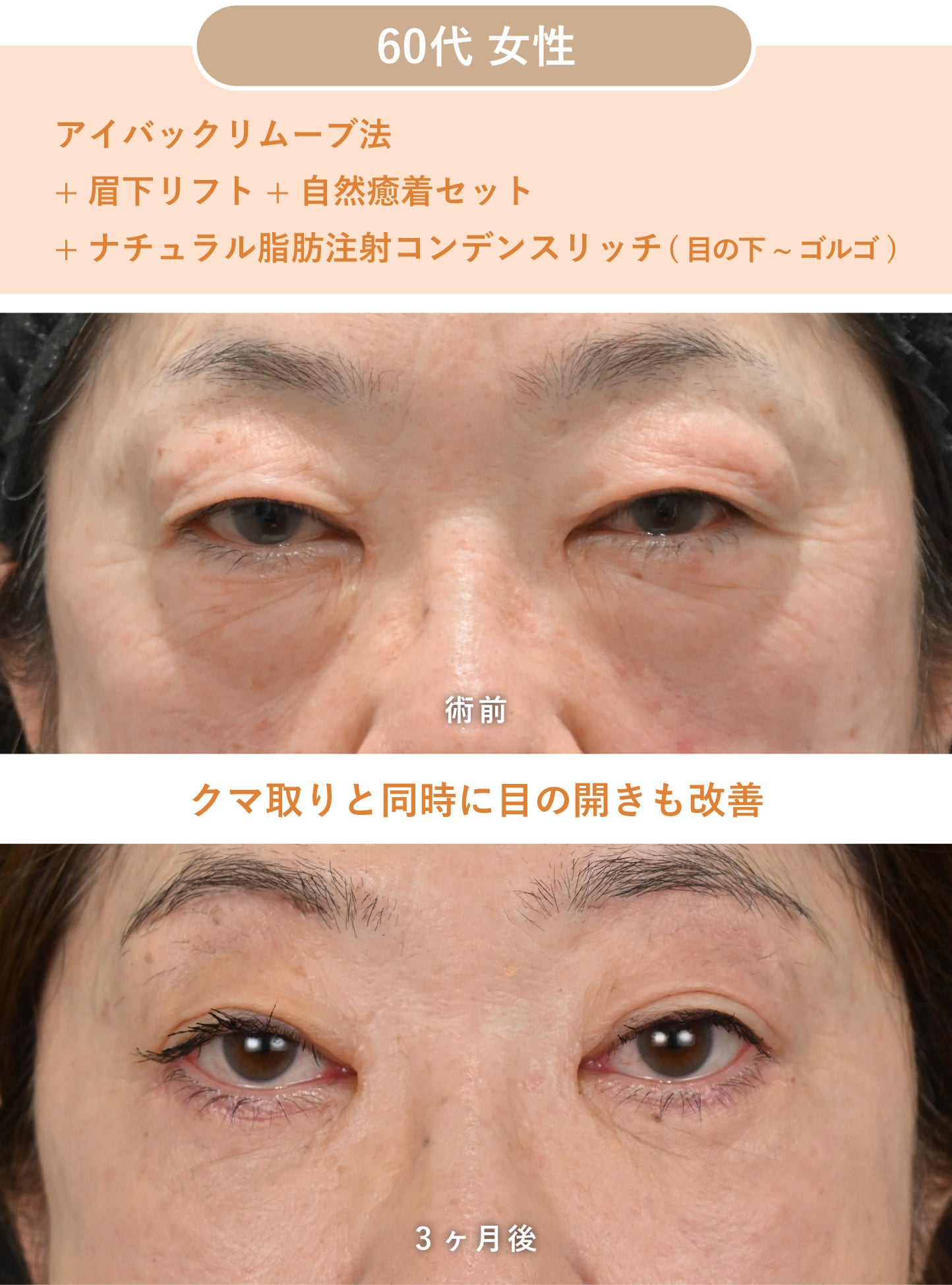目まわりの若返り全般の治療に対応