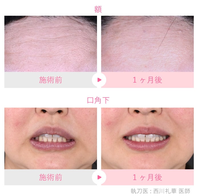 挿入箇所 額・口角下