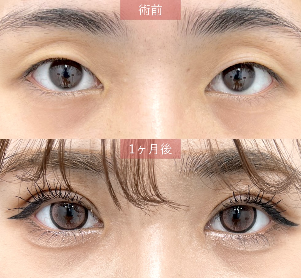 【価格は抑えたいけどデザイン性も諦めたくない方に！】フォーエバー二重術