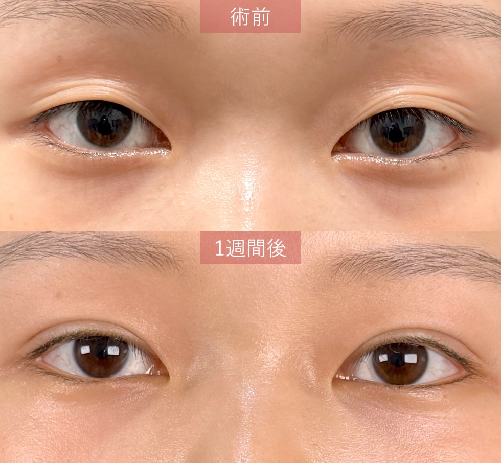 【人気No.1の王道二重術】クイックコスメティークシリーズ