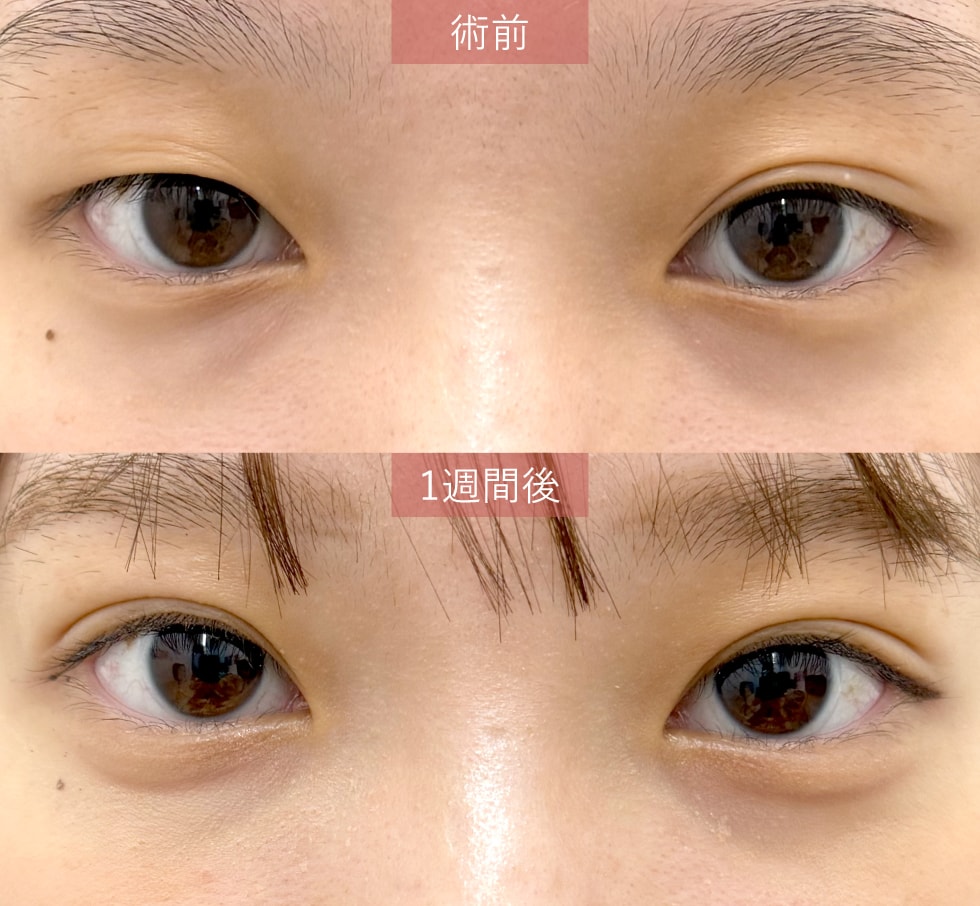 【とにかく価格を抑えたい方に！19歳までの方限定】Teen二重