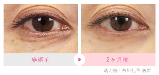 特に効果を発揮するのは「目の下」と「肌質改善」