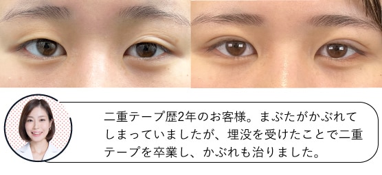 17歳女性の症例