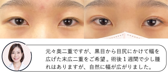 14歳女性の症例