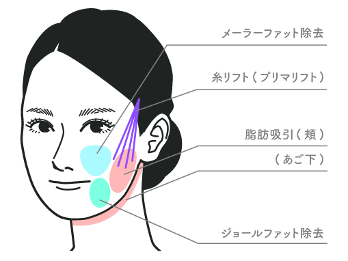 【20代後半：女性】<br />
脂肪吸引(頬+顎下+ジョールファット)<br />
+メーラーファット除去<br />
+プリマリフト8本