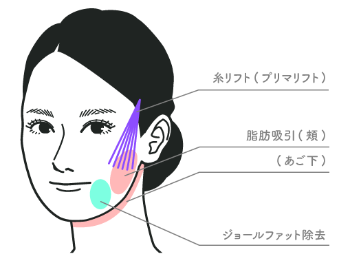 【40代前半：女性】<br />
脂肪吸引(頬+顎下+ジョールファット)<br />
+プリマリフト12本