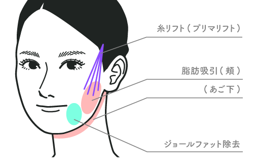【20代後半：男性】<br />
脂肪吸引(頬+顎下+ジョールファット)<br />
+プリマリフト8本