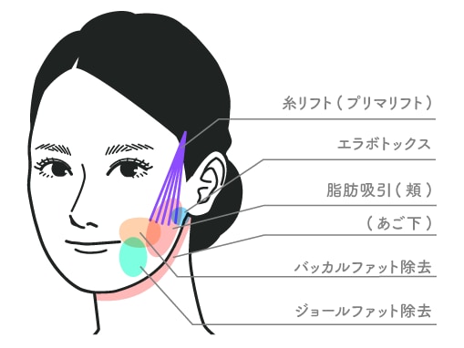 【20代後半：女性】<br />
脂肪吸引(頬+顎下+ジョールファット)<br />
+バッカルファット除去<br />
+プリマリフト10本+エラボトックス