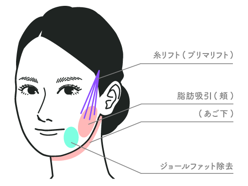 【20代半ば：女性】<br />
脂肪吸引(頬+顎下+ジョールファット)<br />
プリマリフト8本