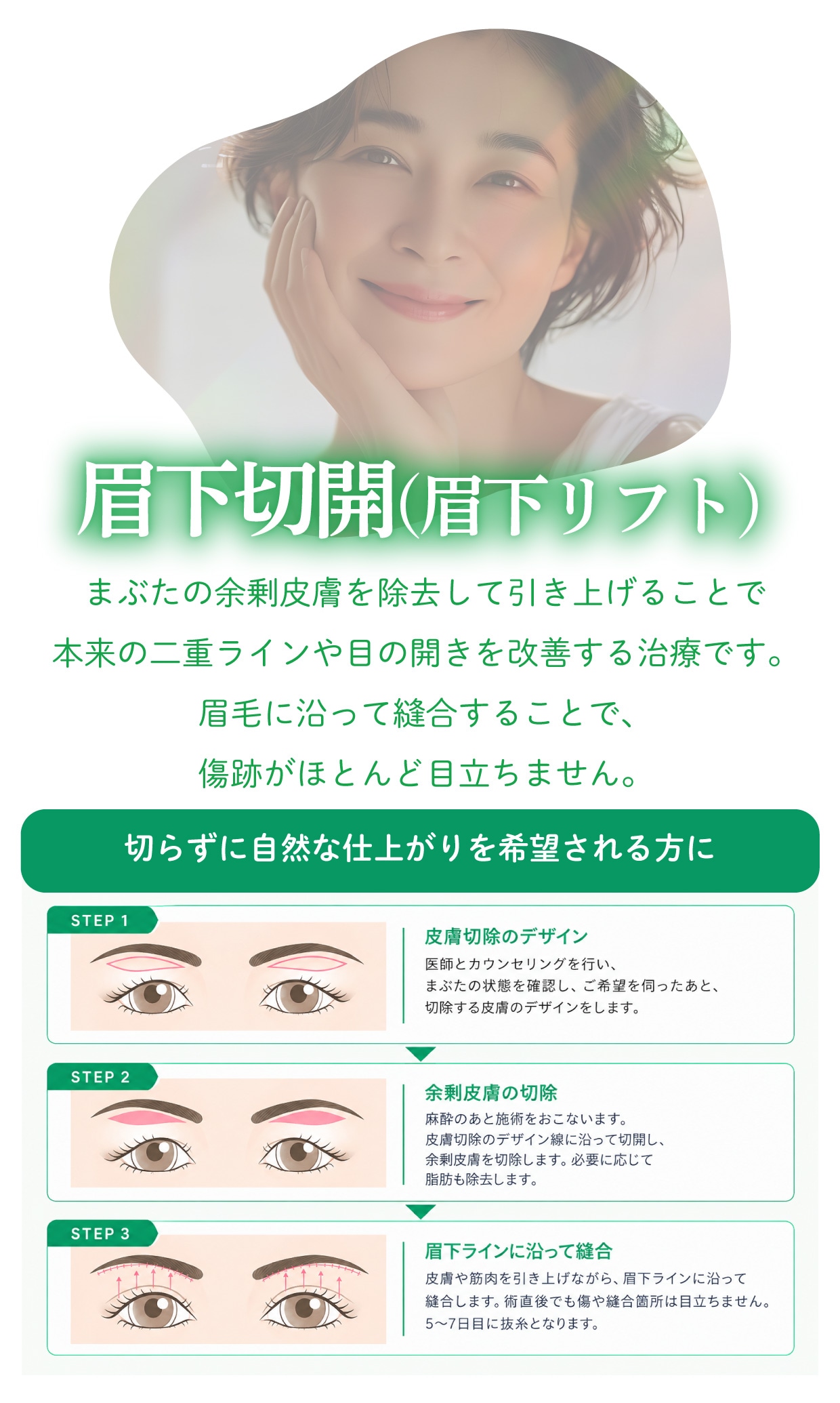 眉下切開(眉下リフト)