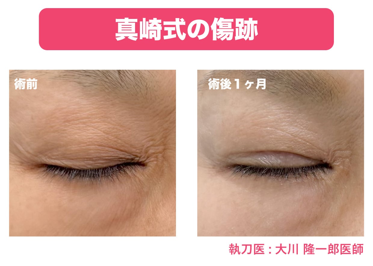 『切らない眼瞼下垂 真崎式』の傷跡