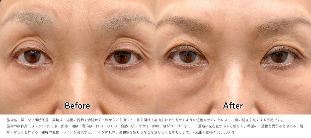 切らない眼瞼下垂真崎式の症例