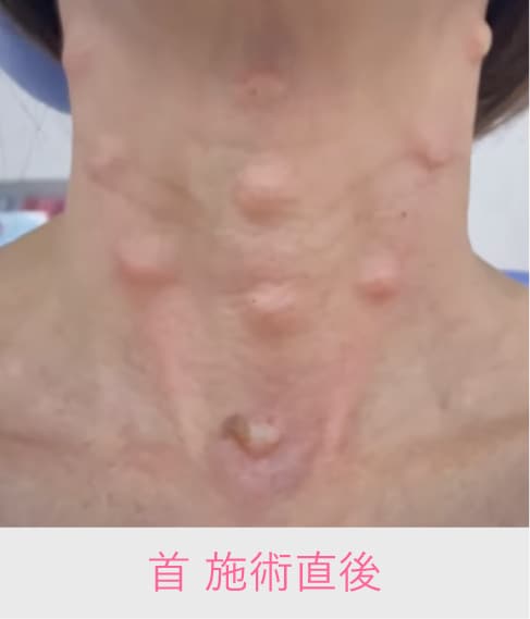 ダウンタイムの経過