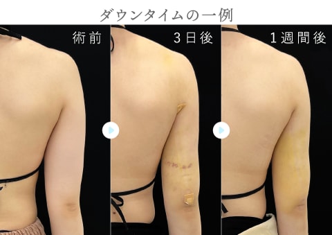 ダウンタイムの一般的な経過