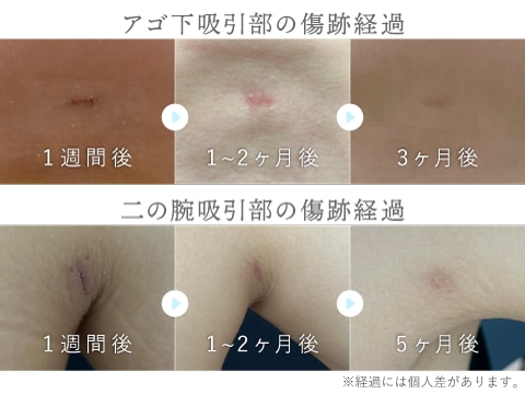 傷跡は残る？目立たなくするための工夫
