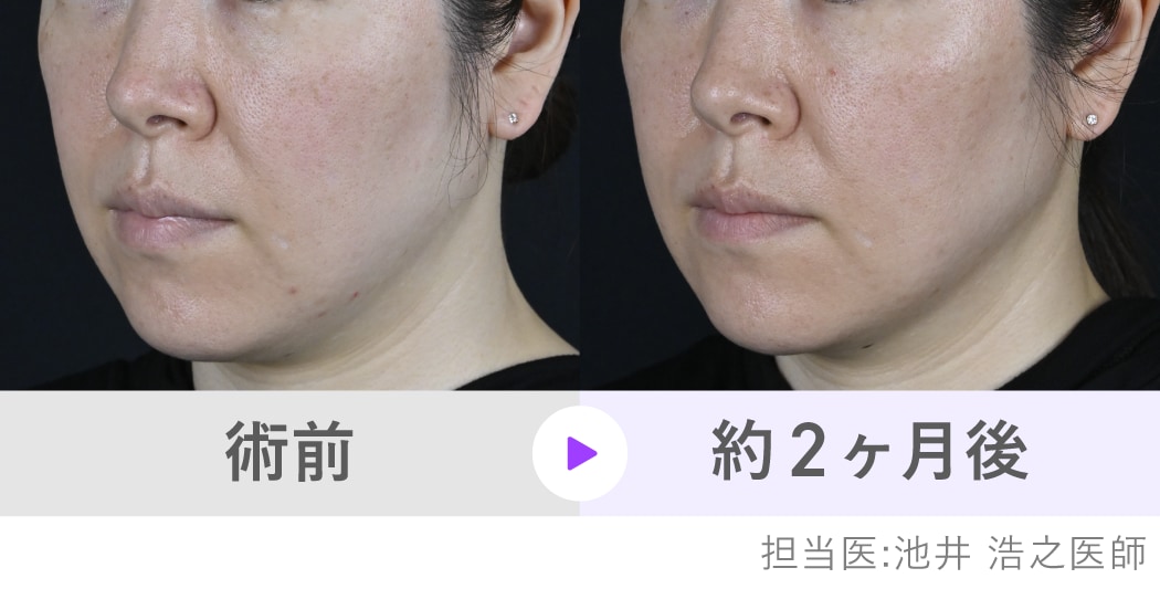 [症例]<br />
頬・フェイスラインのハリ感アップ