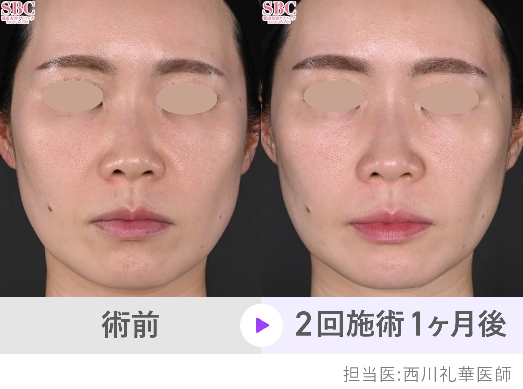 頬のハリ感UPでほうれい線も改善