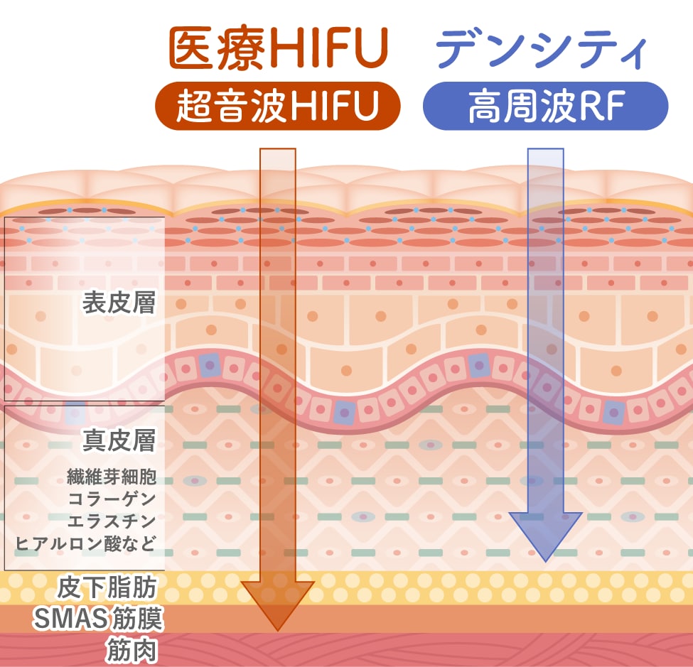 リフトアップ(HIFU)＋引き締め(デンシティ)＝最強のたるみケア