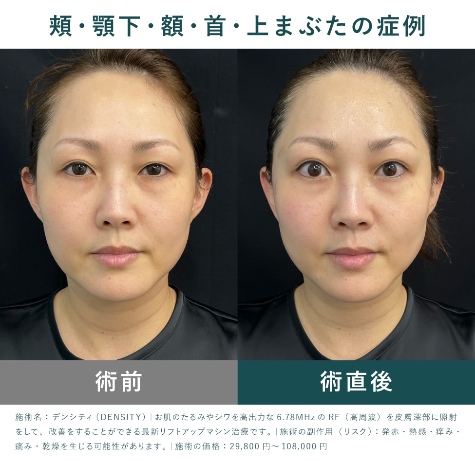 【症例紹介】施術直後から実感できる、引き締め効果とダウンタイムの少なさ