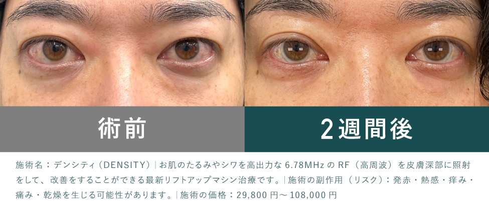 上まぶたの症例