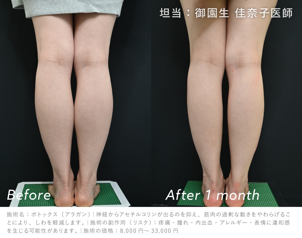 ふくらはぎボトックスの症例