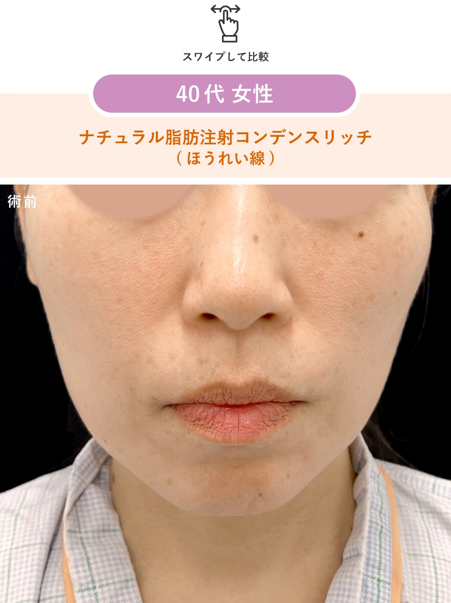 術前