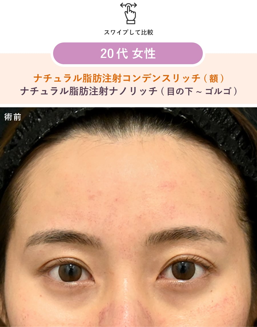 術前