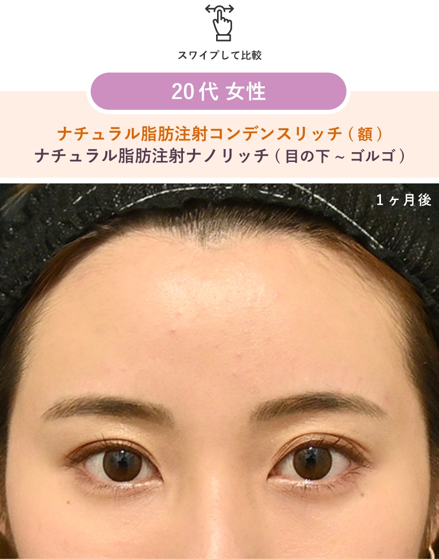 術後