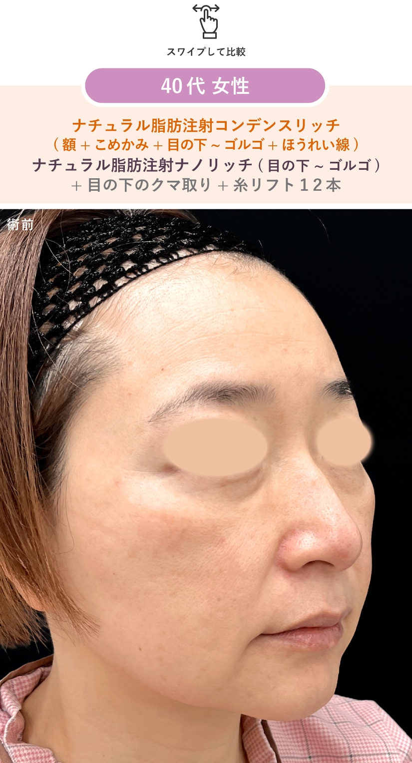 術前