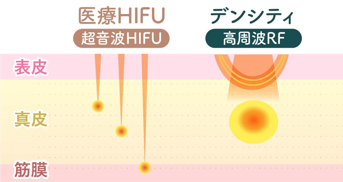 リフトアップ(HIFU)＋引き締め(デンシティ)＝最強のたるみケア