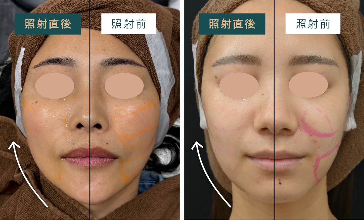 顔の半分だけ照射した比較写真で即効性を証明