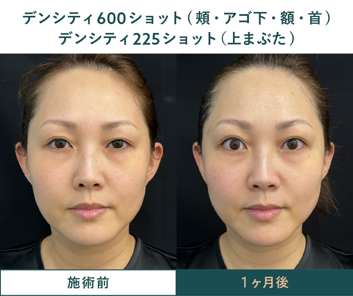 お顔全体のたるみ・もたつき改善症例