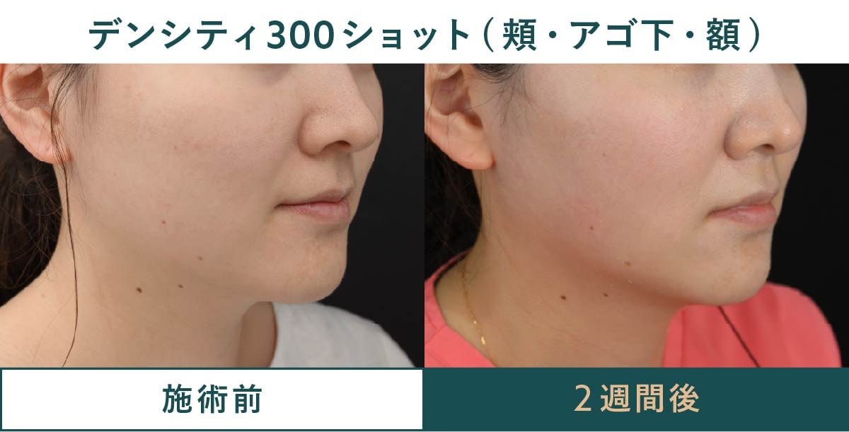 フェイスライン改善症例