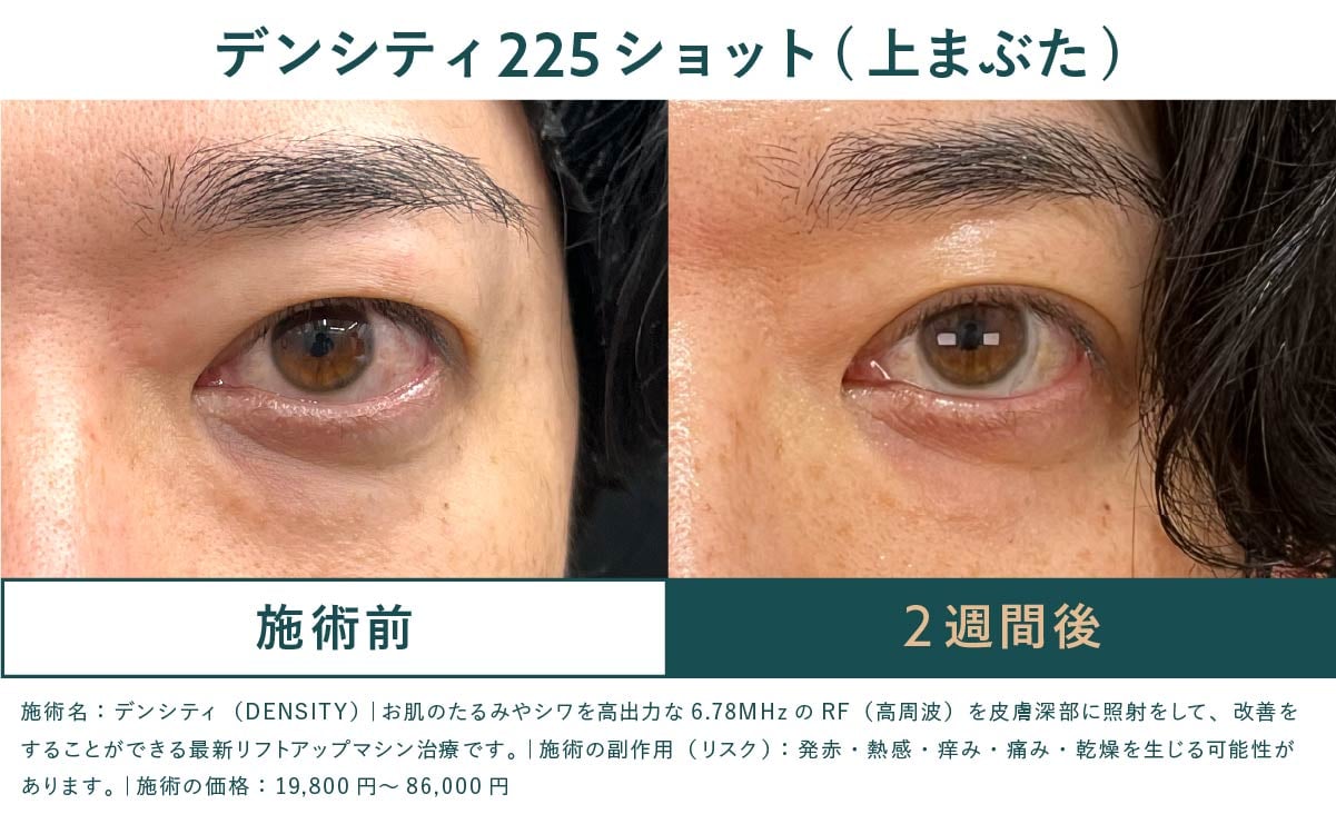 他の治療では難しい「目元のたるみ（まぶた）」の引き上げ症例