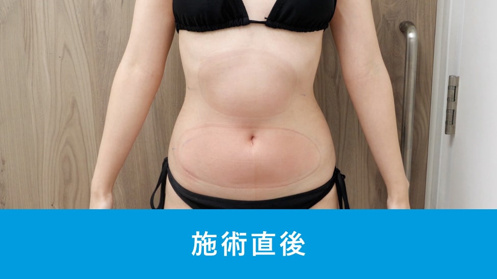 Q. ダウンタイムや施術後の過ごし方で、気をつけることはありますか?