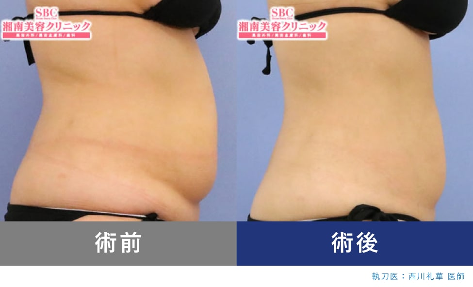 【腹部】ぽっこりお腹の脂肪をすっきりと