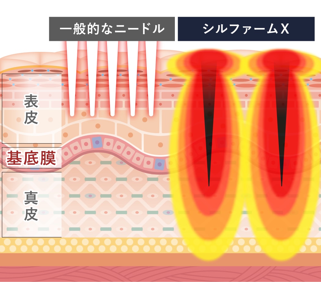 マイクロニードルRF|針と高周波(RF)のW効果で肌を再構築