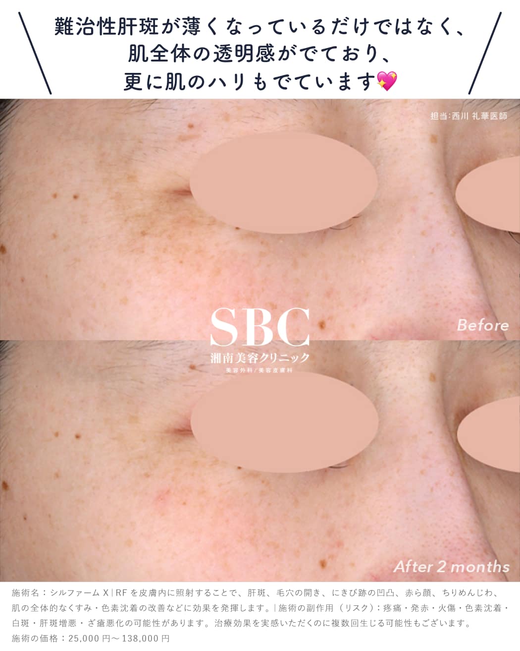これまで諦めていた<br />
「肝斑(かんぱん)」治療が可能に