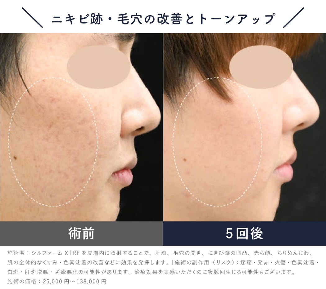 毛穴・ニキビ跡・赤ら顔も同時に改善
