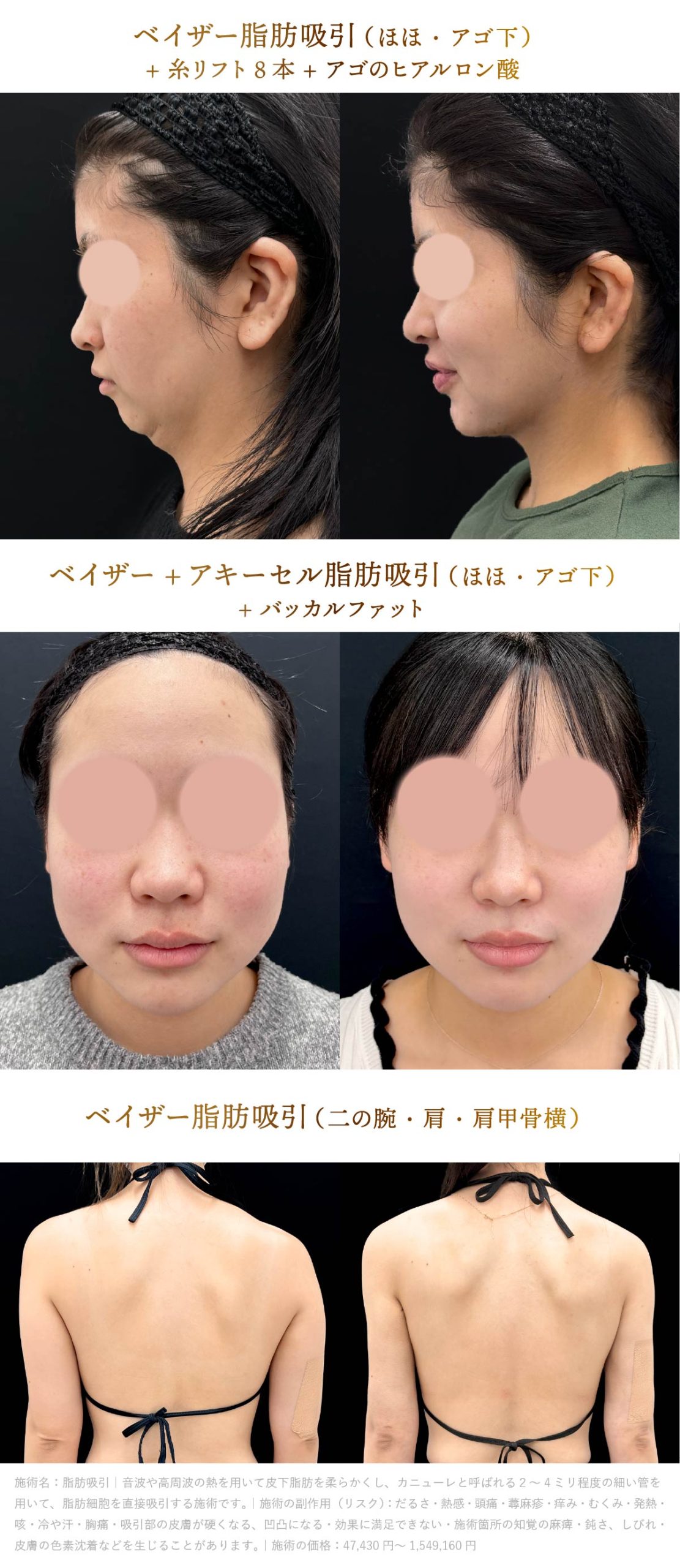 大川院長の脂肪吸引症例画像