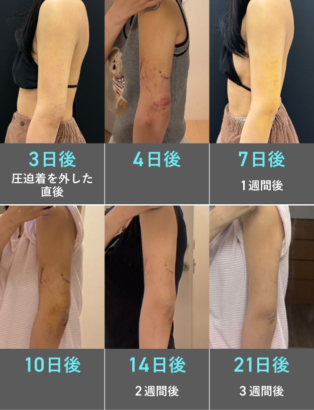 ダウンタイムの一般的な経過目安