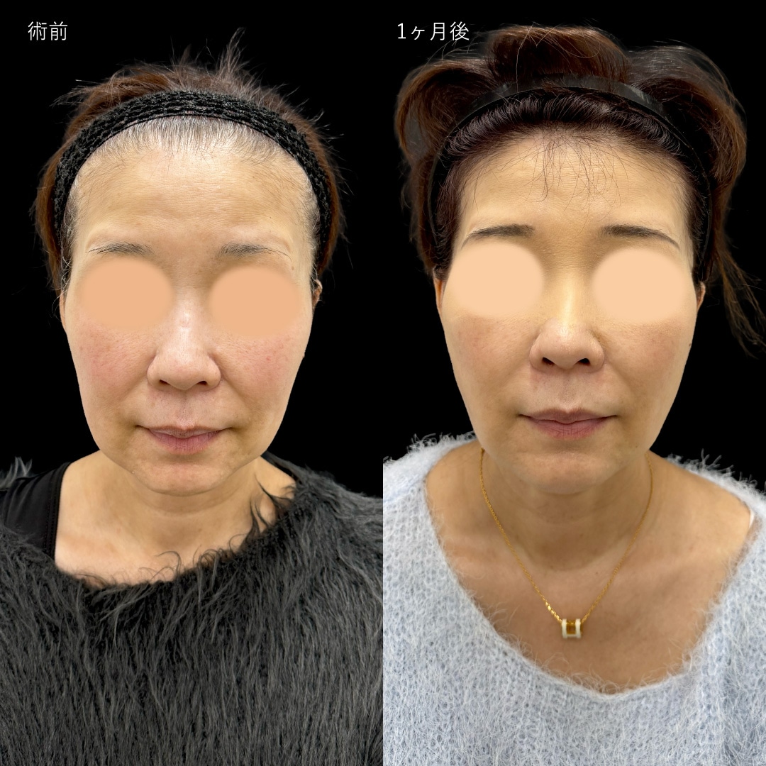 シークレット14本＋VOVリフト6本＋ヒアルロン酸(ほうれい線)