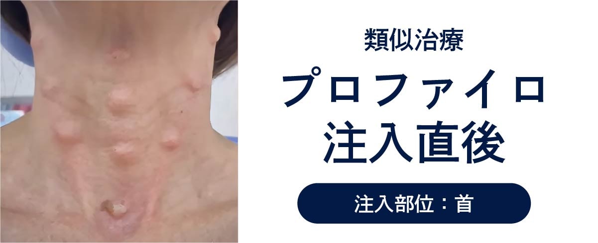 ボコボコになる？ダウンタイムと大事な予定前の注意点