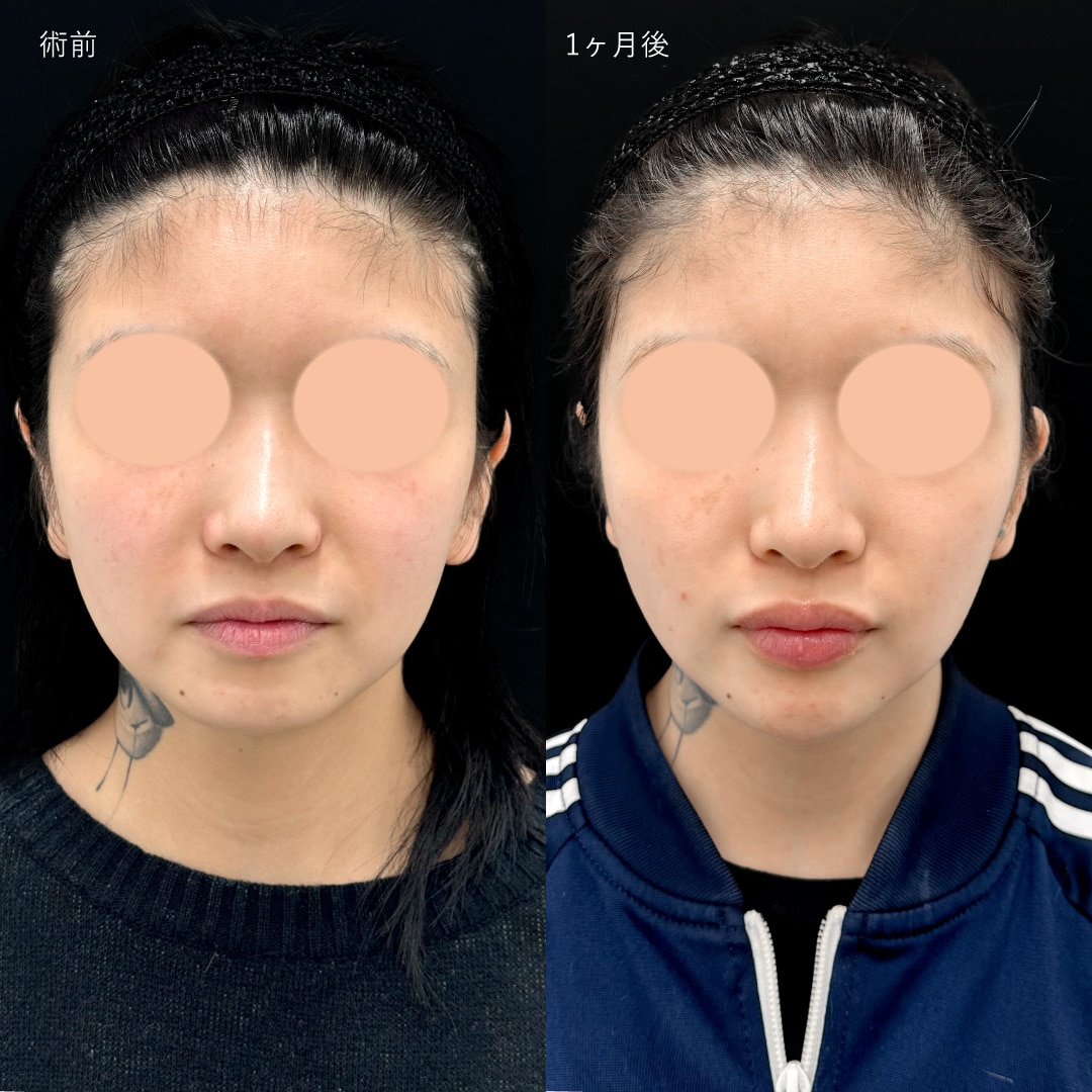 ベイザー脂肪吸引(ほほ＋アゴ下)＋ジョールファット除去＋プリマリフト8本