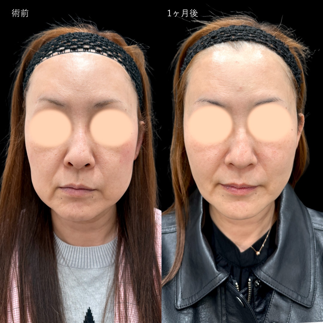 脂肪吸引注射(ほほ)＋ジョールファット除去＋シークレットリフト6本＋プリマリフト4本